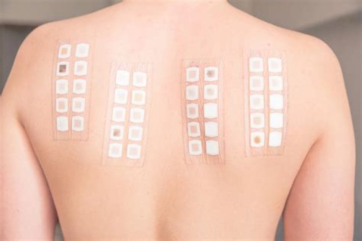 Are skin patch tests accurate?