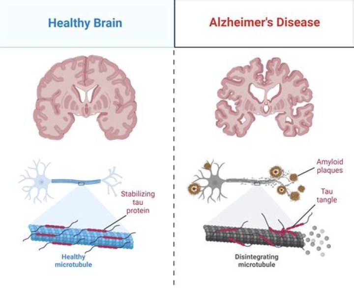Can grief cause Alzheimer's?