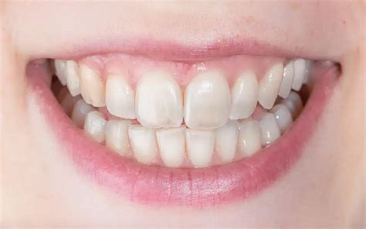 Can you whiten teeth with craze lines?