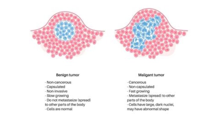 Do benign tumors grow?
