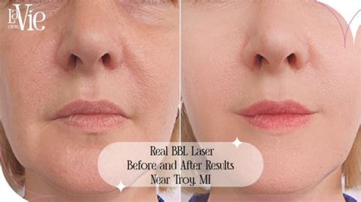 Does BBL laser tighten skin?