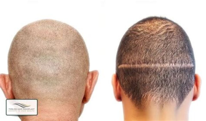 Does fue leave scars?