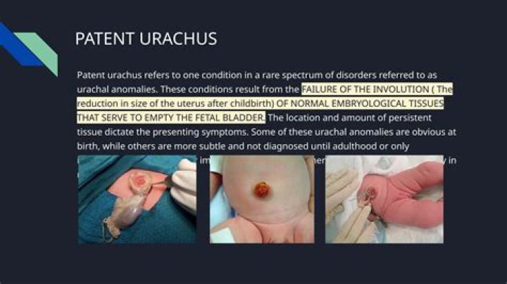 How is patent Urachus diagnosed?
