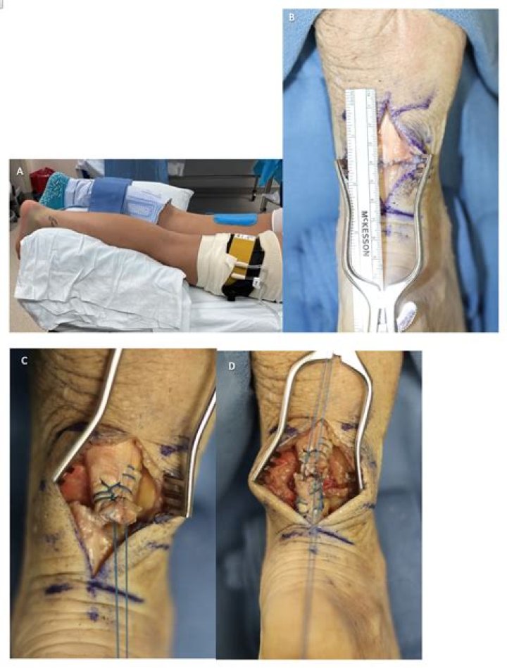 How long is the surgery for a ruptured Achilles tendon?