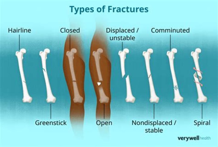 Is fracture covered by insurance?