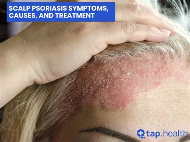 Is giloy good for psoriasis?