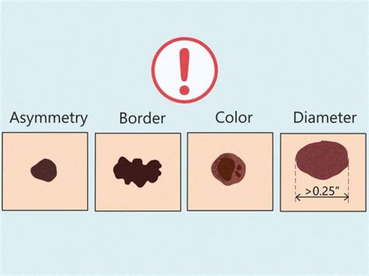 Is it possible to have a mole on your nipple?