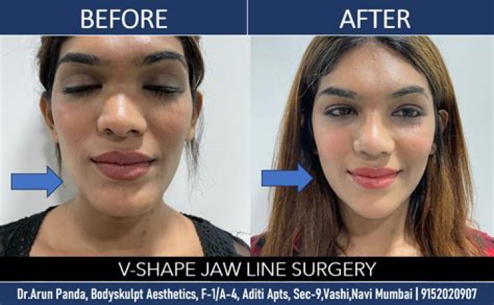 Is jawline surgery safe?