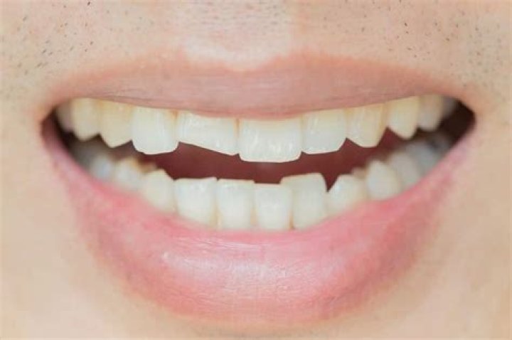 Quelle est la meilleure mutuelle pour les dents ?
