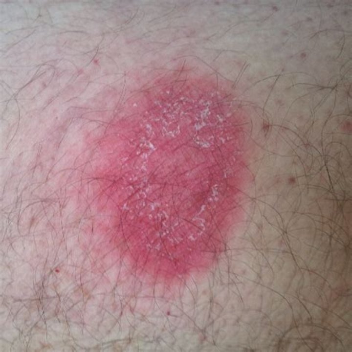 Was ist wenn Zeckenbiss anschwillt?