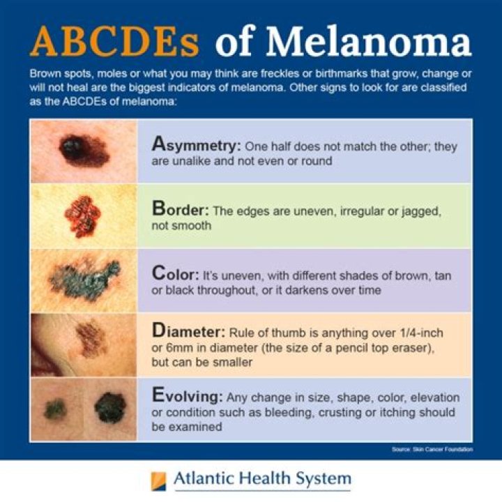 What does pediatric melanoma look like?