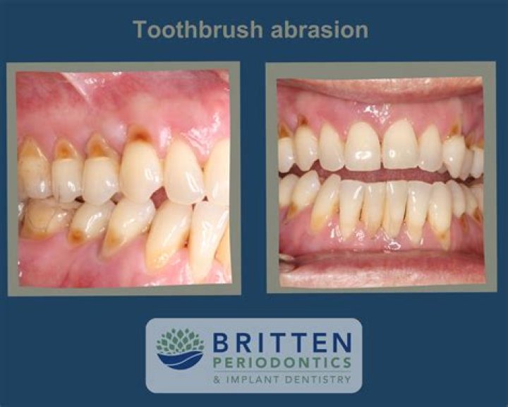 What does tooth abrasion look like?