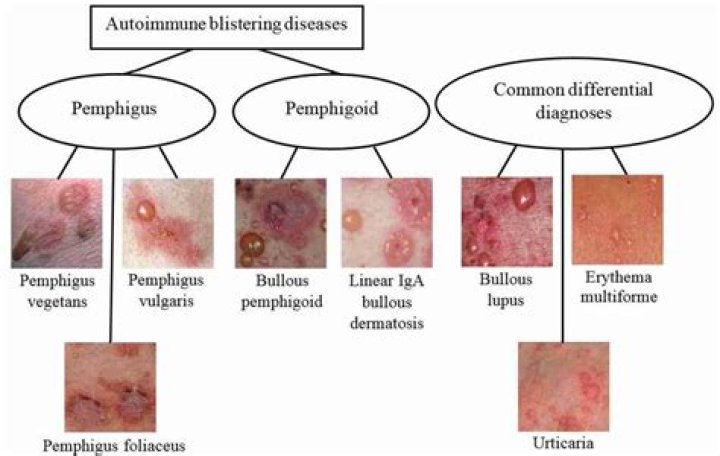 What type of disease is pemphigus?